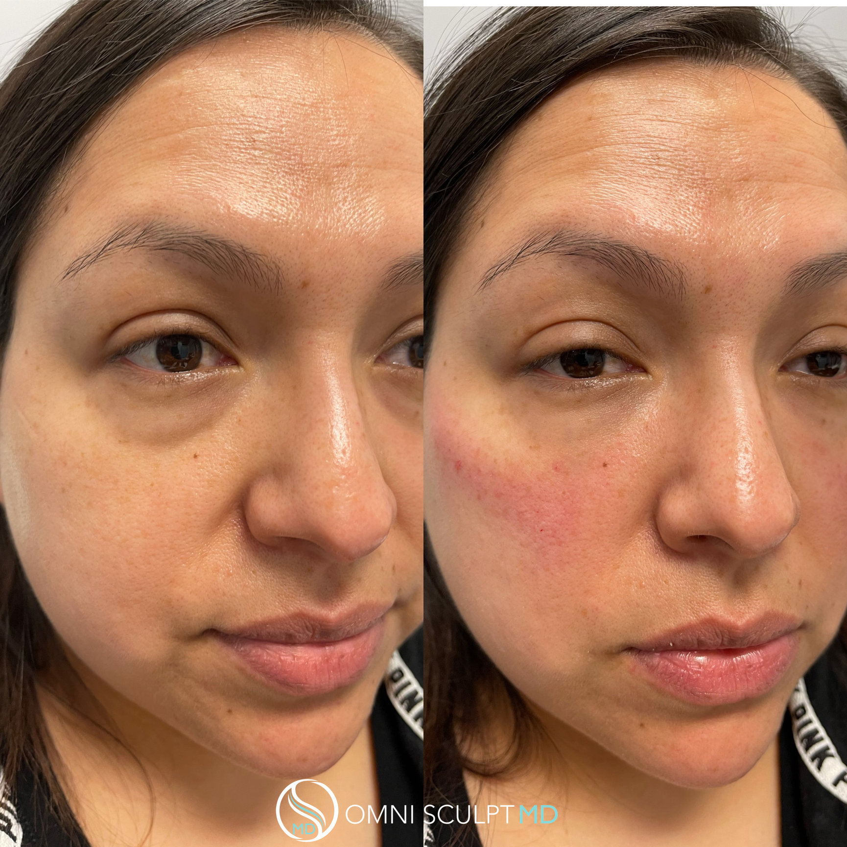 Under Eye Filler Before & After Gallery OMNI SCULPT MD