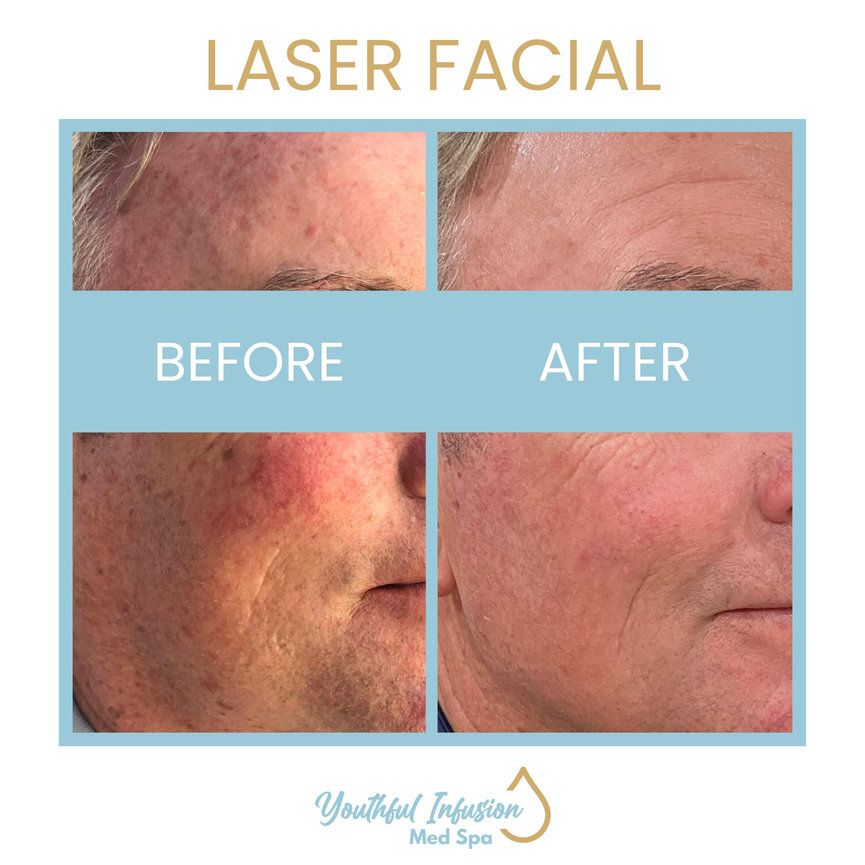 LASER FACIAL BEFORE AND AFTER Youthful Infusion Med Spa