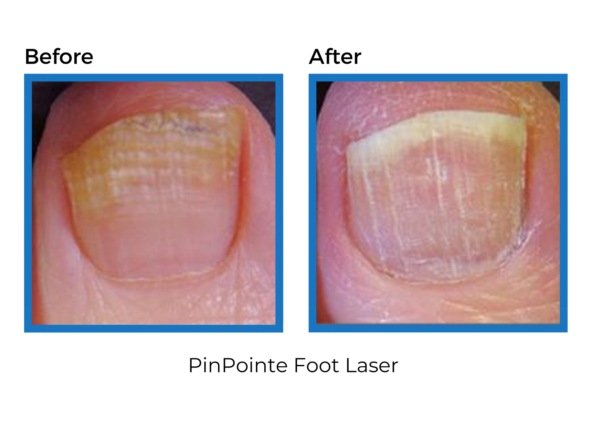 Laser Fungal Nail Treatment Foot & Ankle Centers of Frisco and Plano