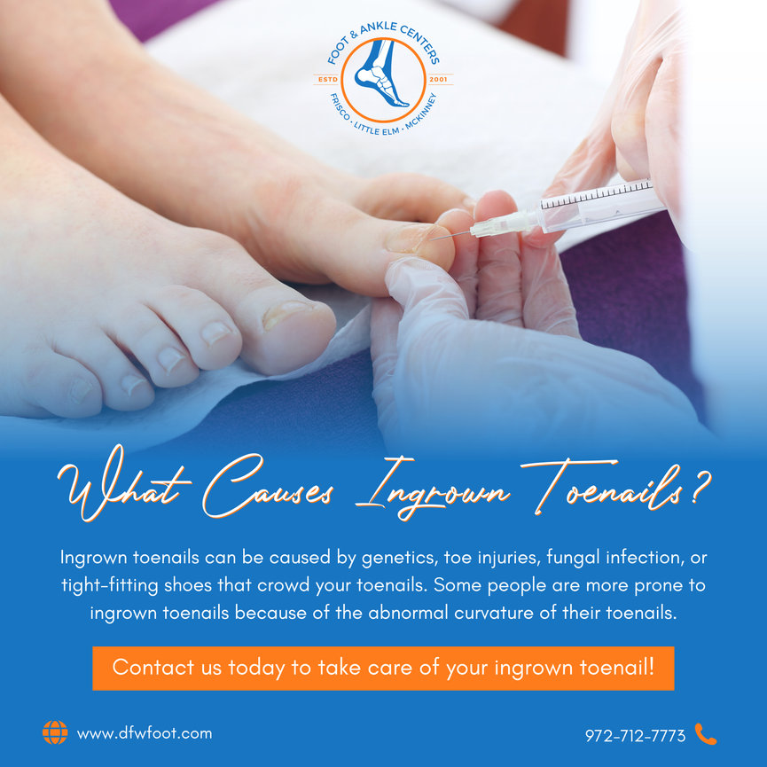 What Causes Ingrown Toenails in Frisco, Little Elm, and McKinney, TX ...