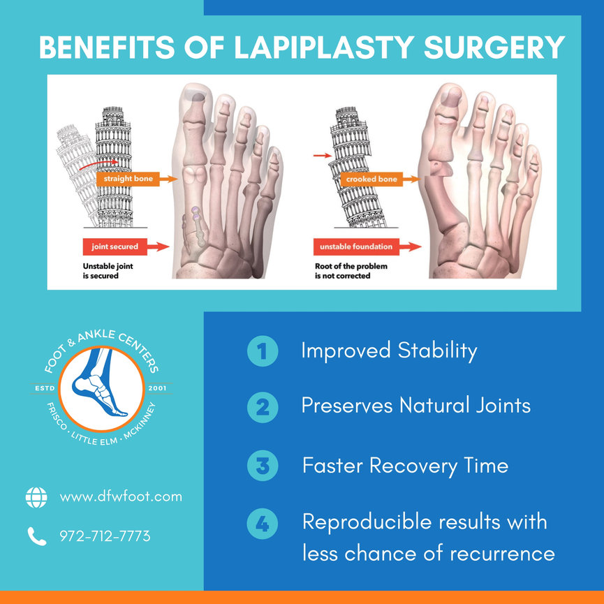 Benefits of Lapiplasty Bunion Correction in Frisco, Little Elm, and