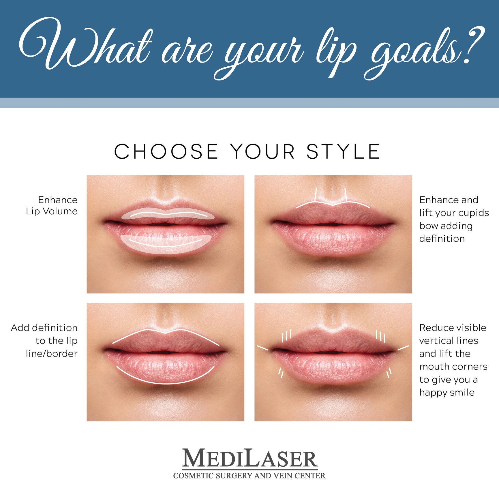 Lip Enhancement 3a - Renew MediSpa