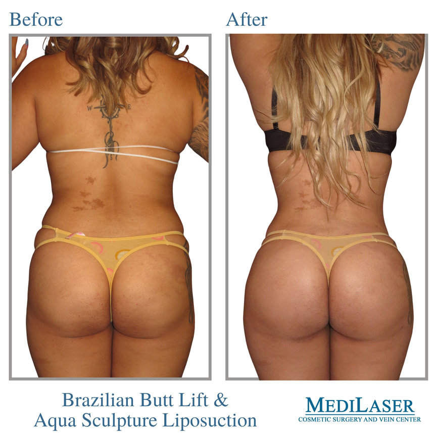 Brazilian Butt Lift Before and After - Medilaser Surgery and Vein