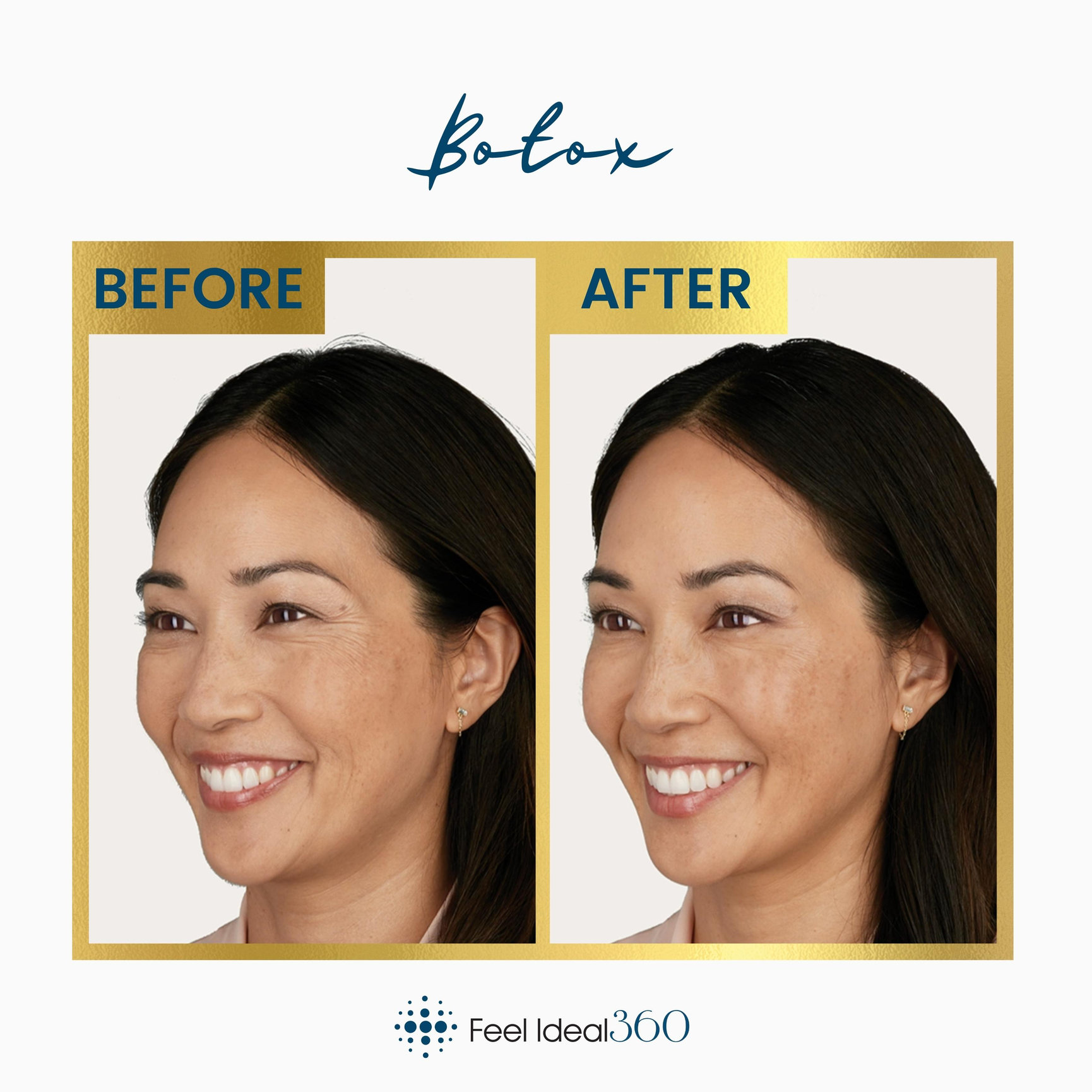 Botox Before And After Feel Ideal 360 Med Spa Southlake Tx