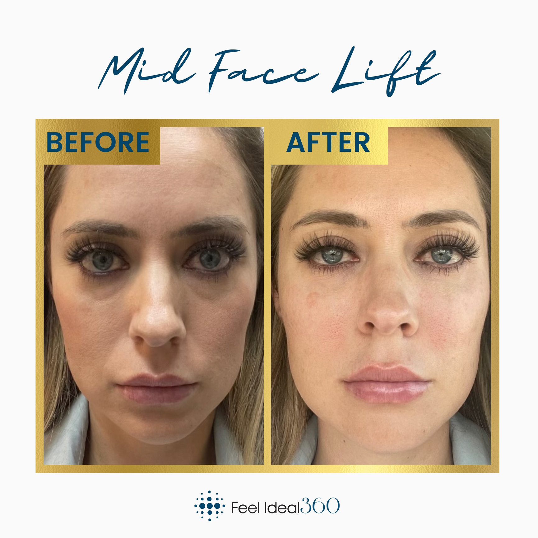 Facial Filler Before and After Feel Ideal 360 Med Spa Southlake, TX