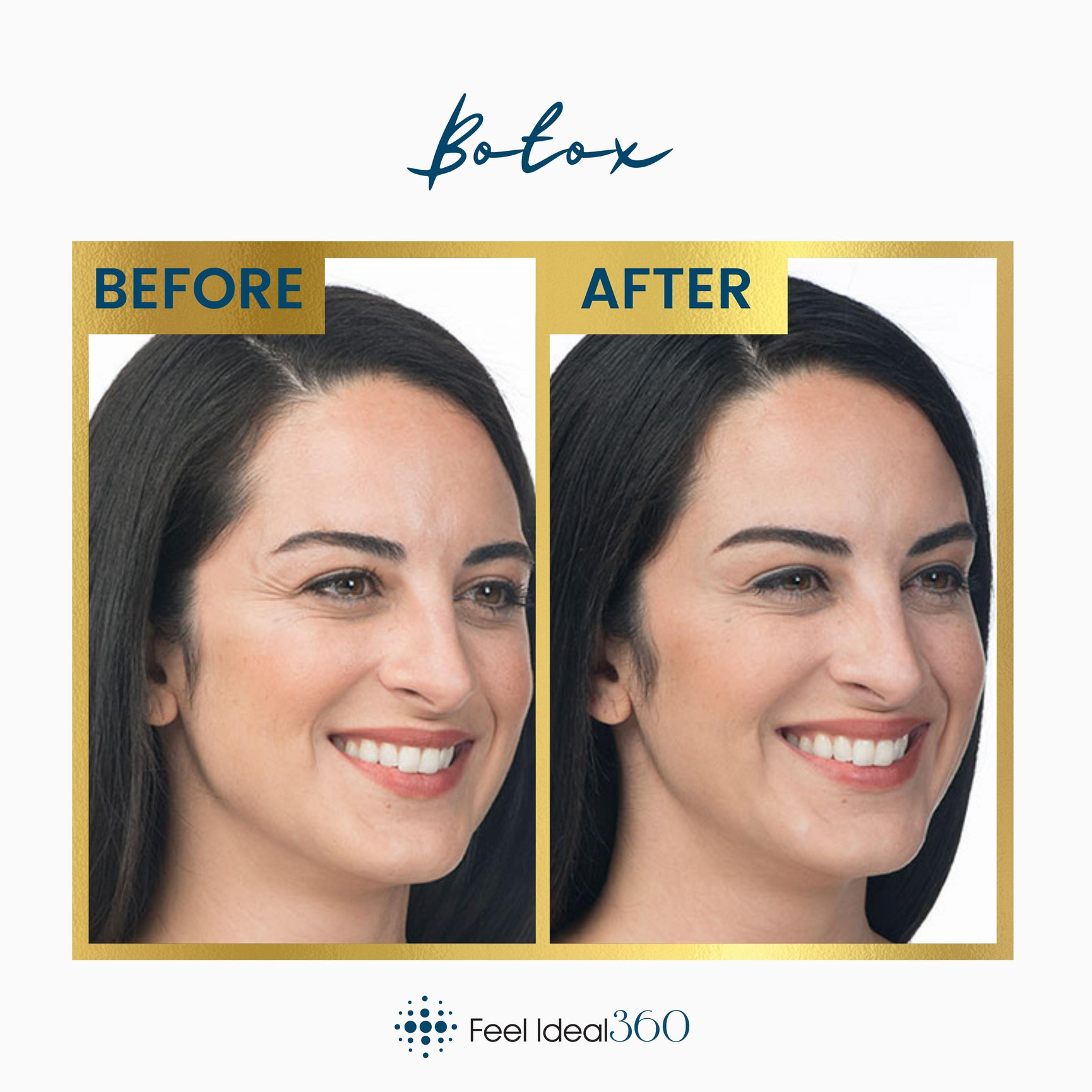 Botox® Feel Ideal 360 Med Spa Southlake Tx