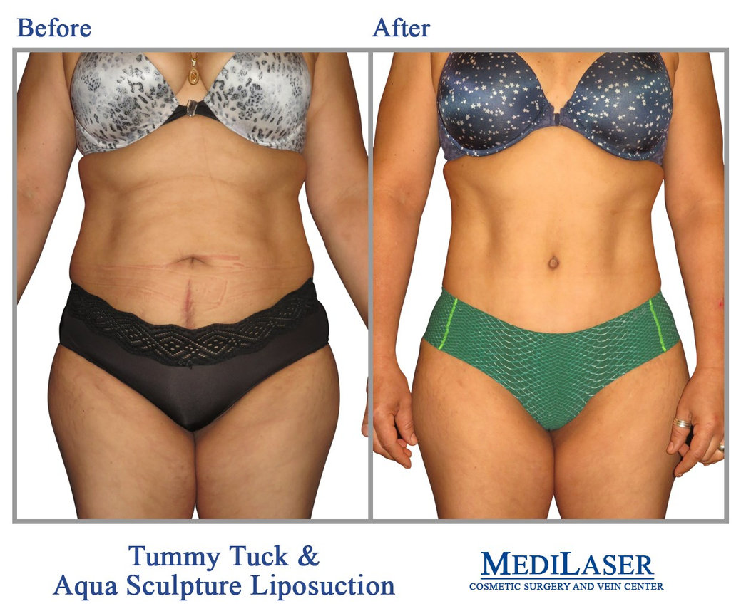 Tummy Tuck and Liposuction Before and After - Medilaser Surgery and Vein  Center